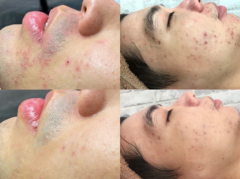 液態皮秒,台北皮秒