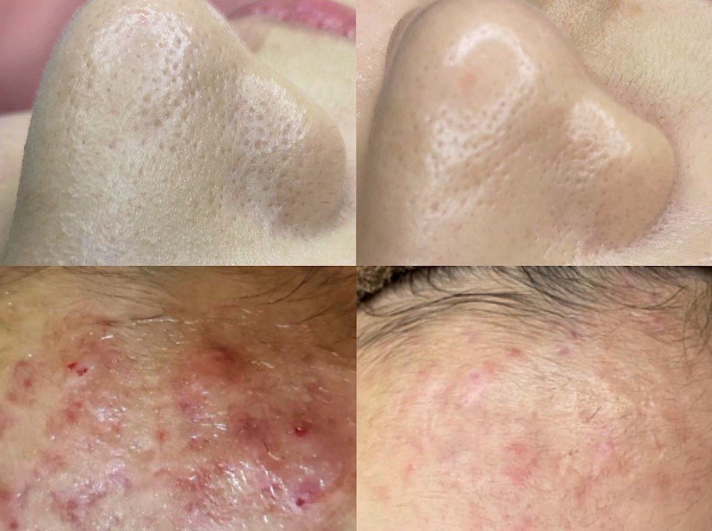 海藻針,藻針,LTS液態海藻針