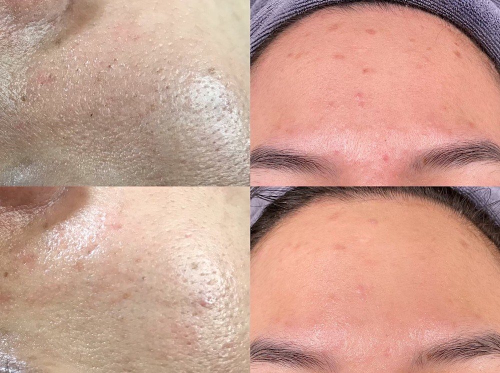 客人皮膚案例-1