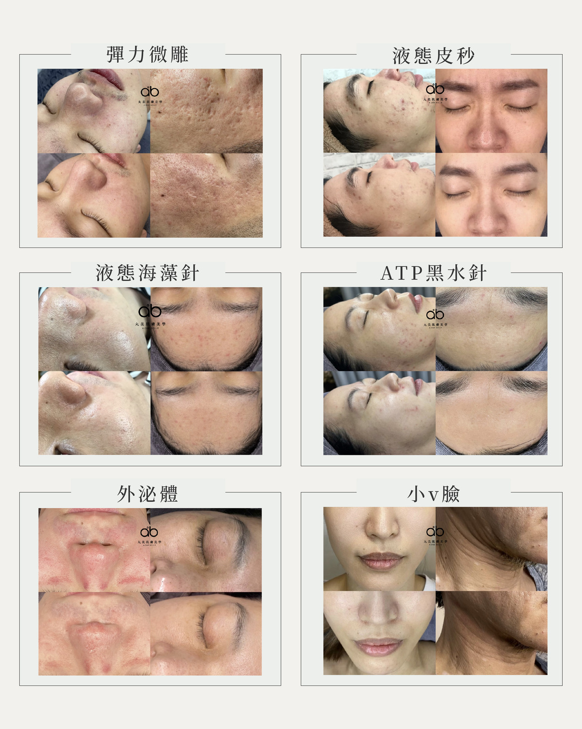 彈力微雕,液態皮秒,液態海藻針,ATP黑水針,外泌體,小V臉